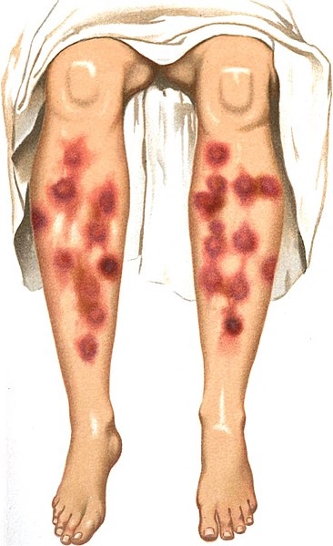 Erythema nodosum